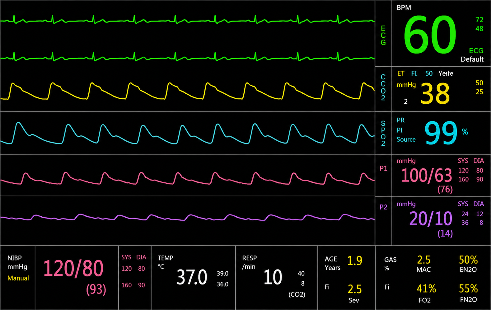 Capnography display example